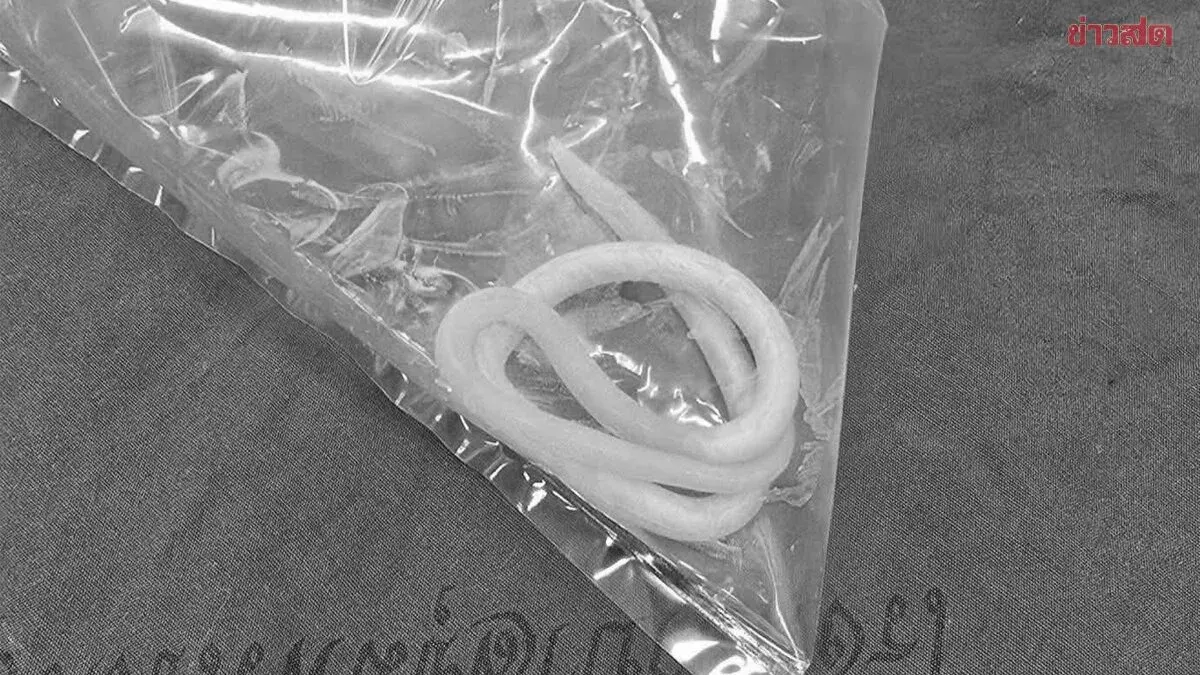 Roundworms Extracted From Toddler's Mouth After Vomiting
