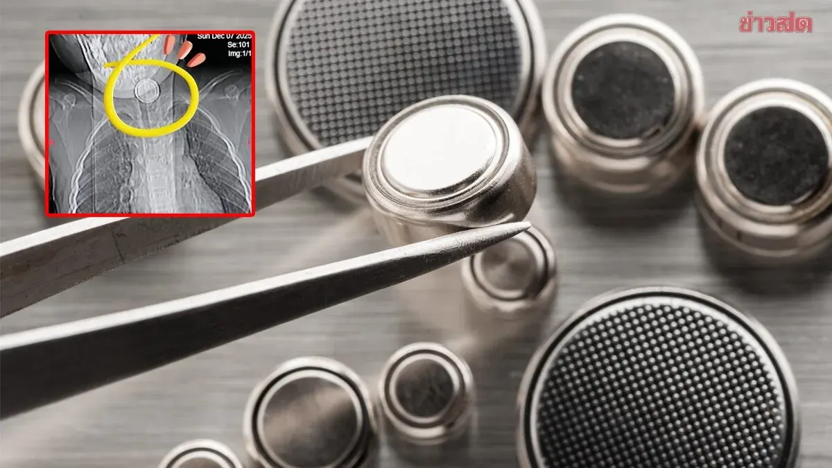 Boy, 4, Swallows Button Battery; Doctors Warn Against Home Remedies