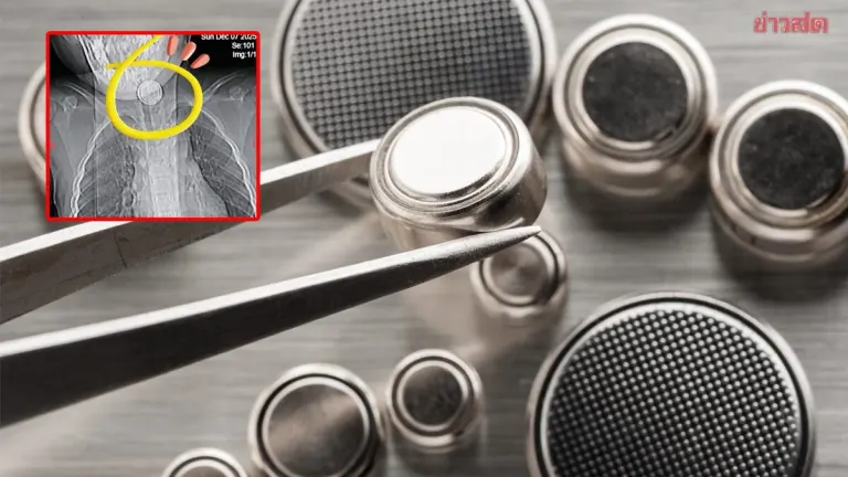 Boy, 4, Swallows Button Battery; Doctors Warn Against Home Remedies