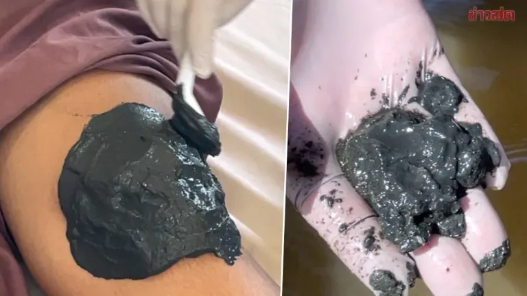 Trang Hospital Uses Black Mud to Treat Knee Arthritis