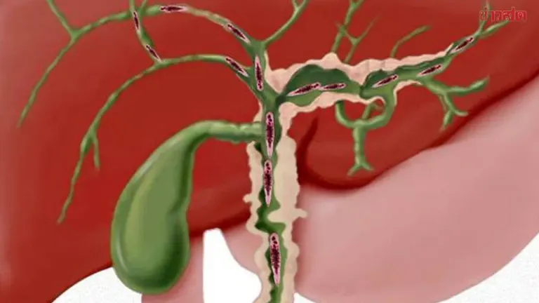 Doctor Explains Why Liver Fluke Infections Plague Northeast Thailand
