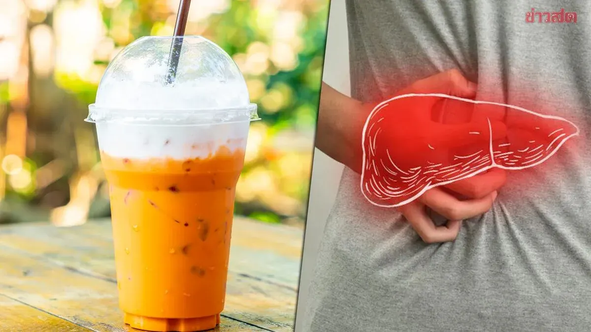 Doctor Details Case of 28-Year-Old Woman With Fatty Liver From Sweet Tea