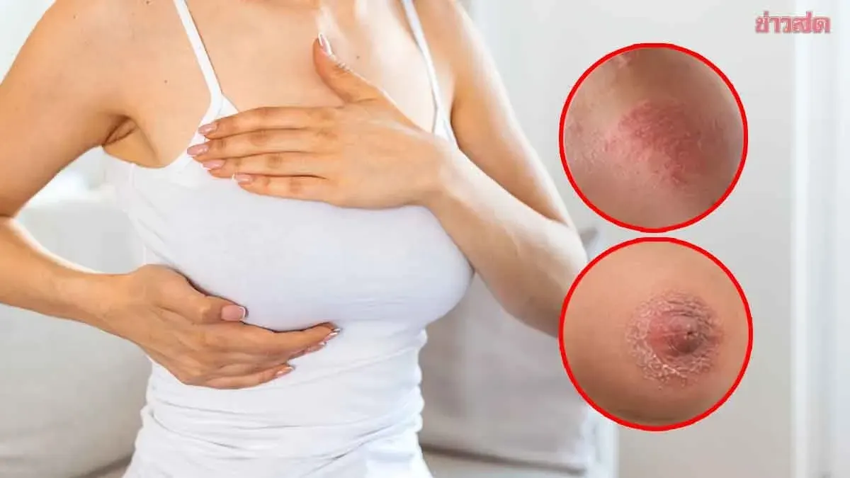 No Lump Doesn't Mean No Breast Cancer, Doctor Warns