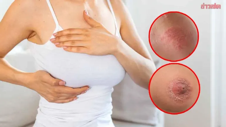 No Lump Doesn't Mean No Breast Cancer, Doctor Warns