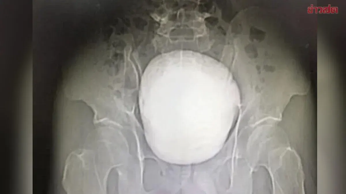 Shocking Discovery: 56-Year-Old Chinese Man with 3-Year Urinary Obstruction Found to Have Giant 1.3kg Bladder Stone, Requires Emergency Surgery