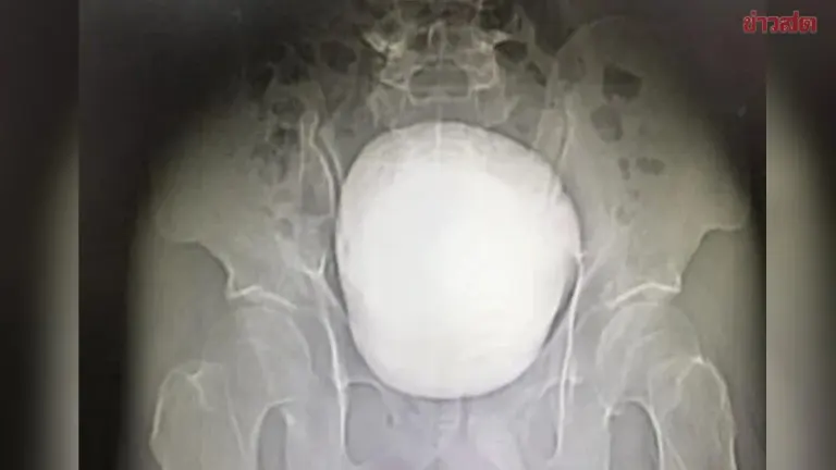 Shocking Discovery: 56-Year-Old Chinese Man with 3-Year Urinary Obstruction Found to Have Giant 1.3kg Bladder Stone, Requires Emergency Surgery