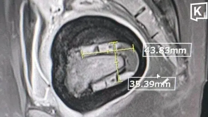 Doctors Remove Stone-Like Mass From Woman's Body