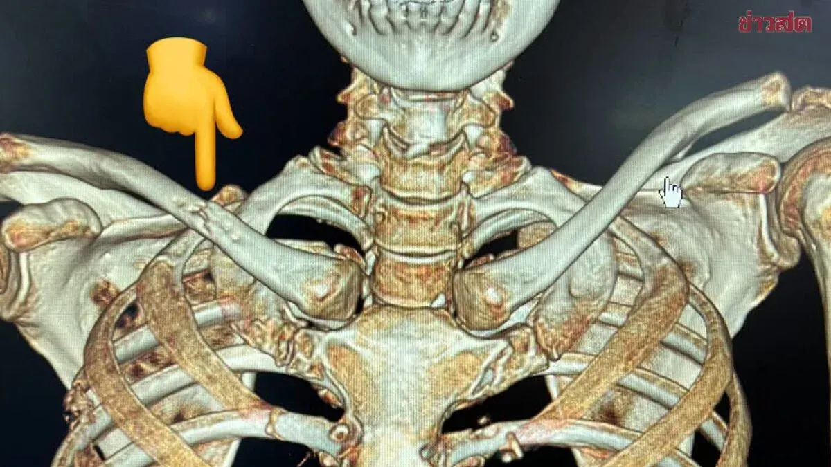 Doctor Warns: Bone Pain May Signal Advanced Lung Cancer