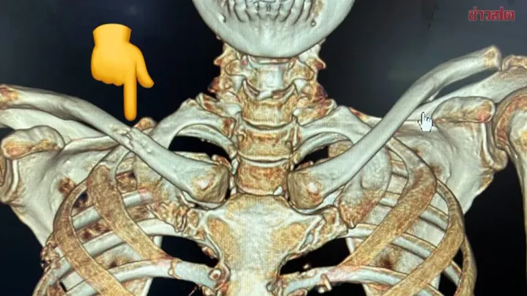 Doctor Warns: Bone Pain May Signal Advanced Lung Cancer