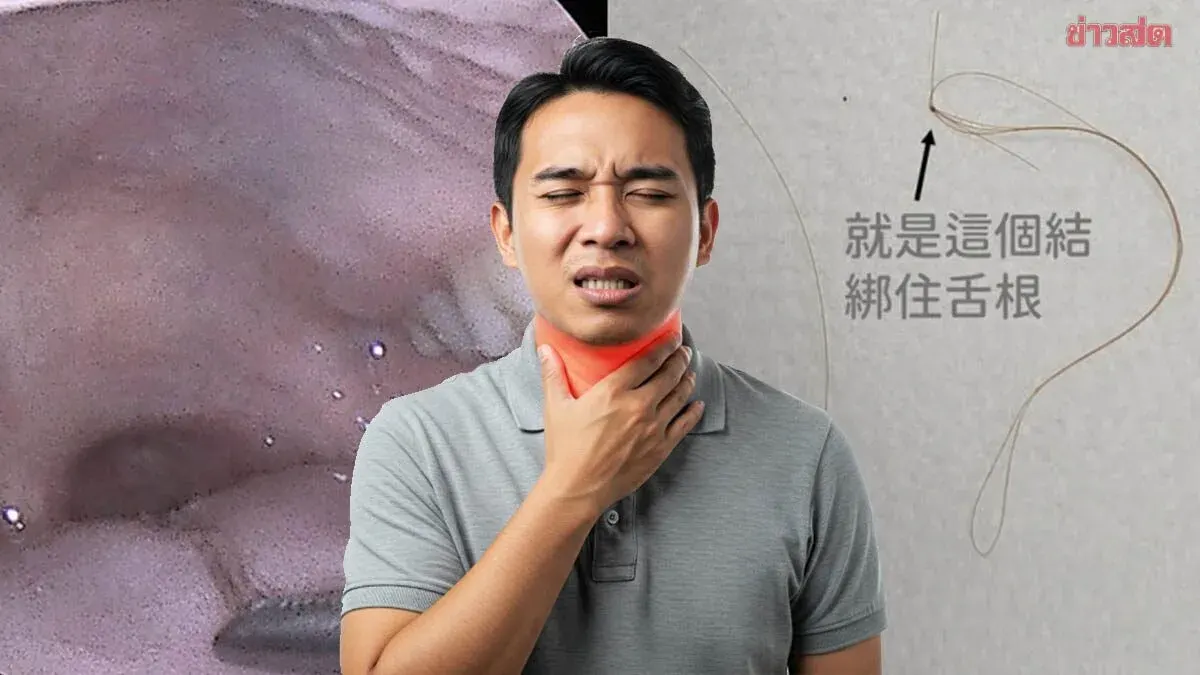 Hair Knot Tangled Around Man's Tongue Base