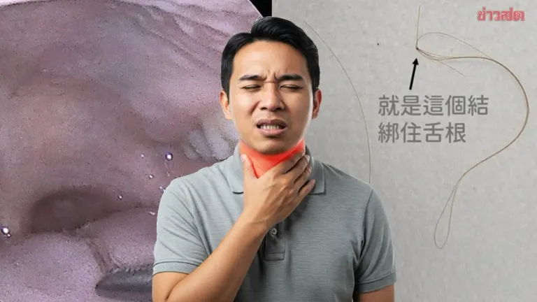 Hair Knot Tangled Around Man's Tongue Base