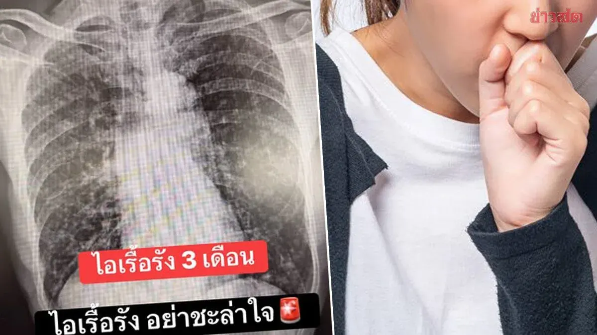 Doctors warn man who smokes 5 cigarettes daily with persistent cough for 3 months diagnosed with lung cancer after self-medicating