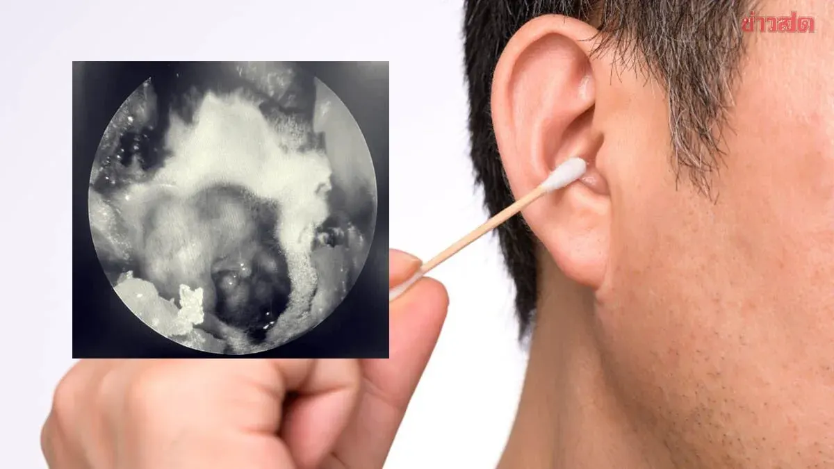 Man's Persistent Ear Fullness Traced to Yellow Fungal Infection on Eardrum