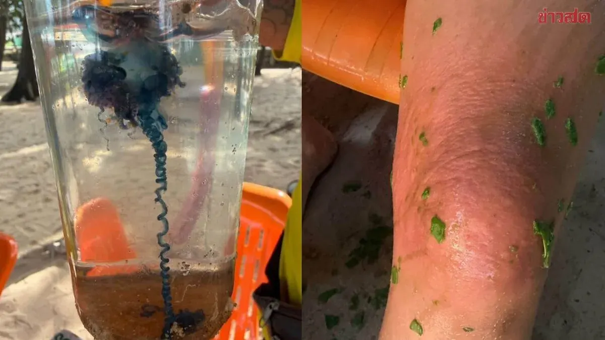 Foreign Tourist Stung by Portuguese Man-of-War at Phuket Beach