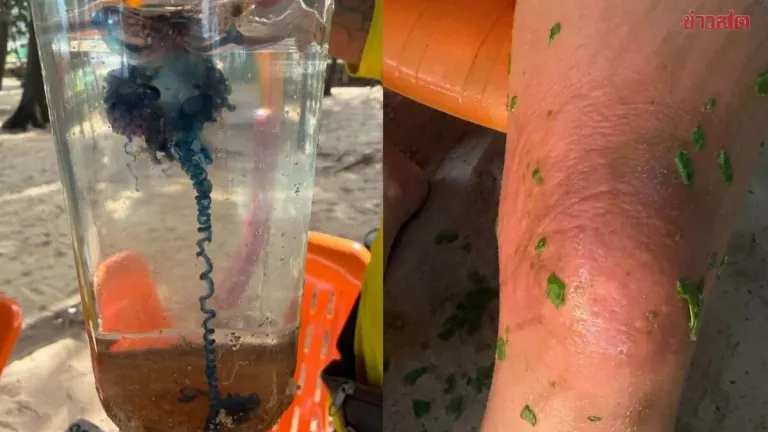Foreign Tourist Stung by Portuguese Man-of-War at Phuket Beach