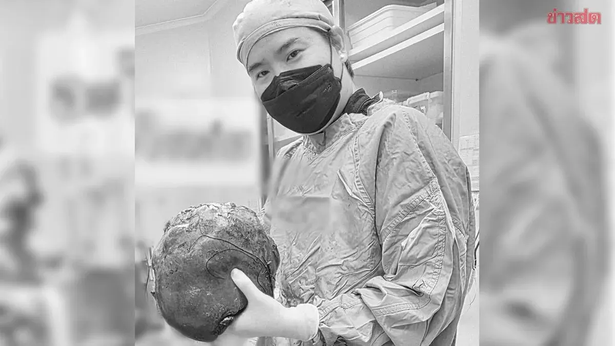 Surgeon Removes One-Foot Liver Cancer in Six-Hour Operation