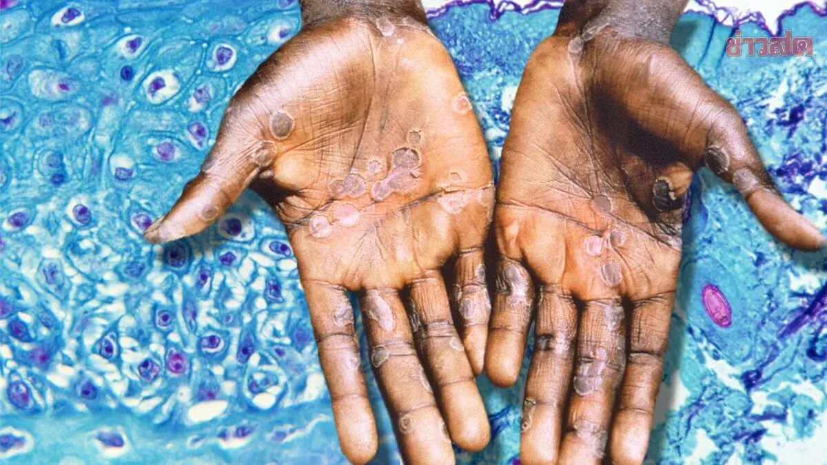 Health Ministry Monitors Mpox Outbreak Following Songkran Festival, 48 Confirmed Cases Reported Predominantly in Males