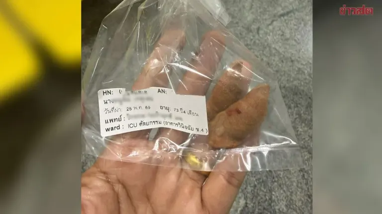 Man Issues Warning After His Mother Swallows Betel Nut Seeds That Perforated Her Stomach and Intestines, Requiring Surgery That Could Have Been Fatal