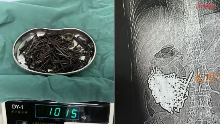 Surgeon Removes 180 Nails, Coins From Patient's Stomach