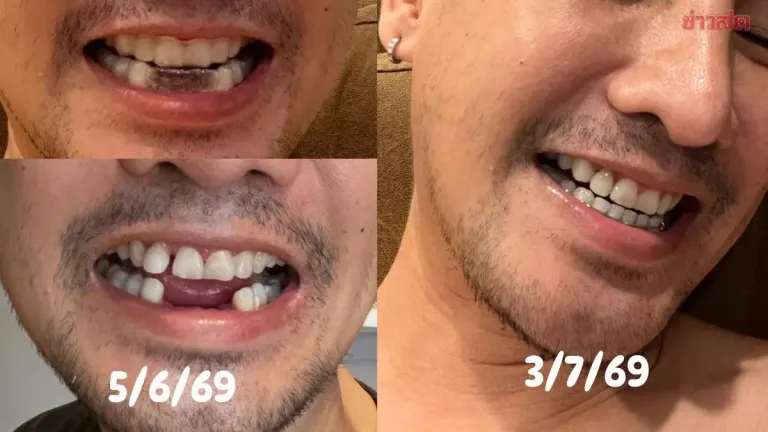 Man's Four Teeth Knocked Out During ICU Emergency Treatment