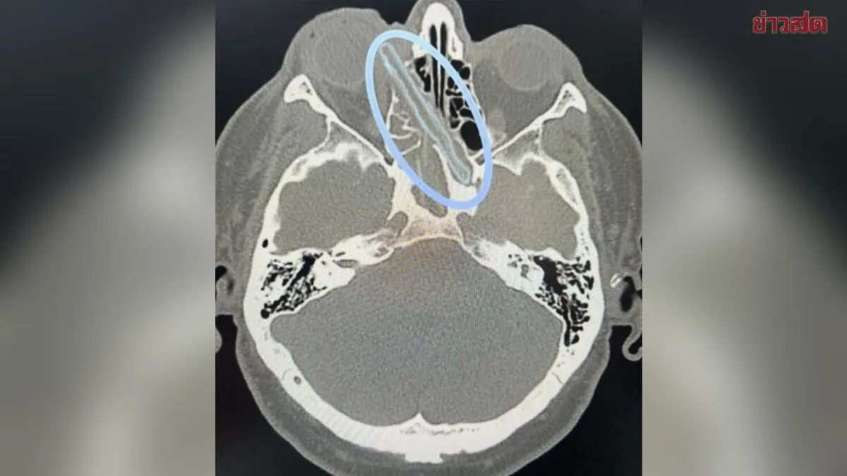 Doctors Stunned: 12cm Wooden Branch Removed from Russian Man's Eye Socket After 18 Months Embedded in Skull