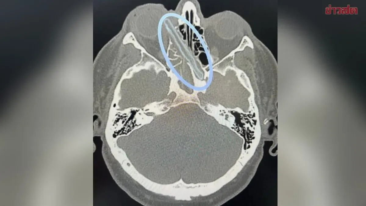 Doctors Stunned: 12cm Wooden Branch Removed from Russian Man's Eye Socket After 18 Months Embedded in Skull