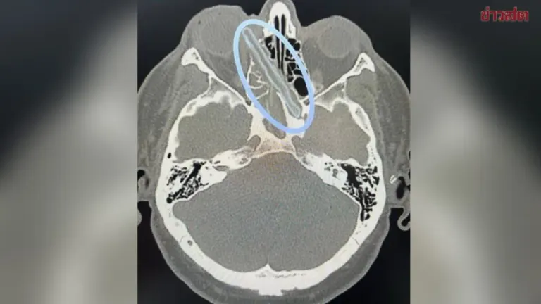 Doctors Stunned: 12cm Wooden Branch Removed from Russian Man's Eye Socket After 18 Months Embedded in Skull