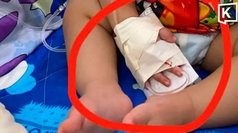 Toddler Loses Finger in Hospital Scissors Accident