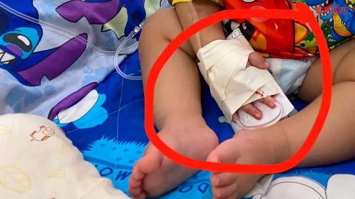Nurse's Scissors Slip, Severing One-Year-Old's Finger During IV Removal
