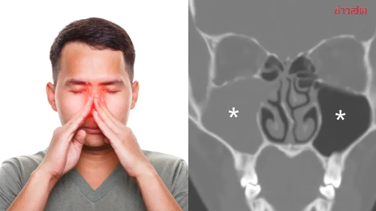 Tooth Extraction Leads to Severe Sinus Infection in 20-Year-Old
