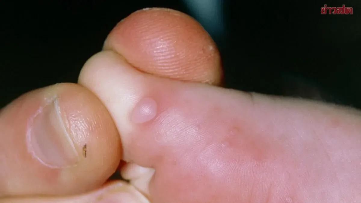 Suspected Hand-Foot-and-Mouth Disease Claims 5-Year-Old in Buriram