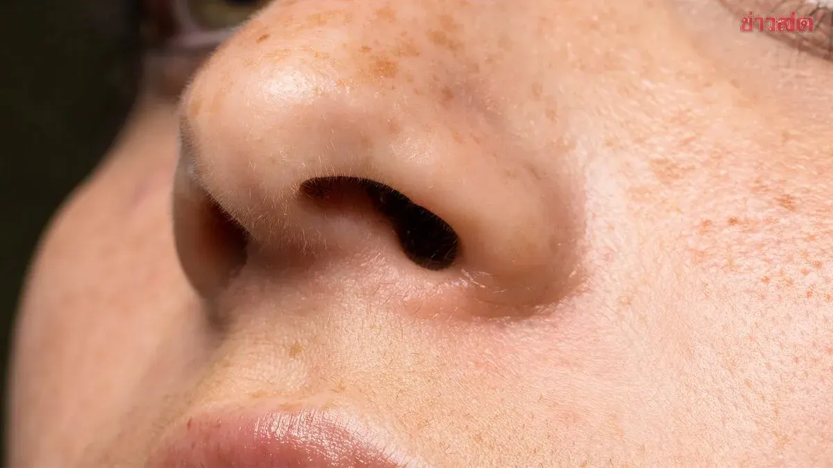 Clear Skin Without Blemishes, But Wrong Drug Use—Doctor Warns of Blood Clot Risk