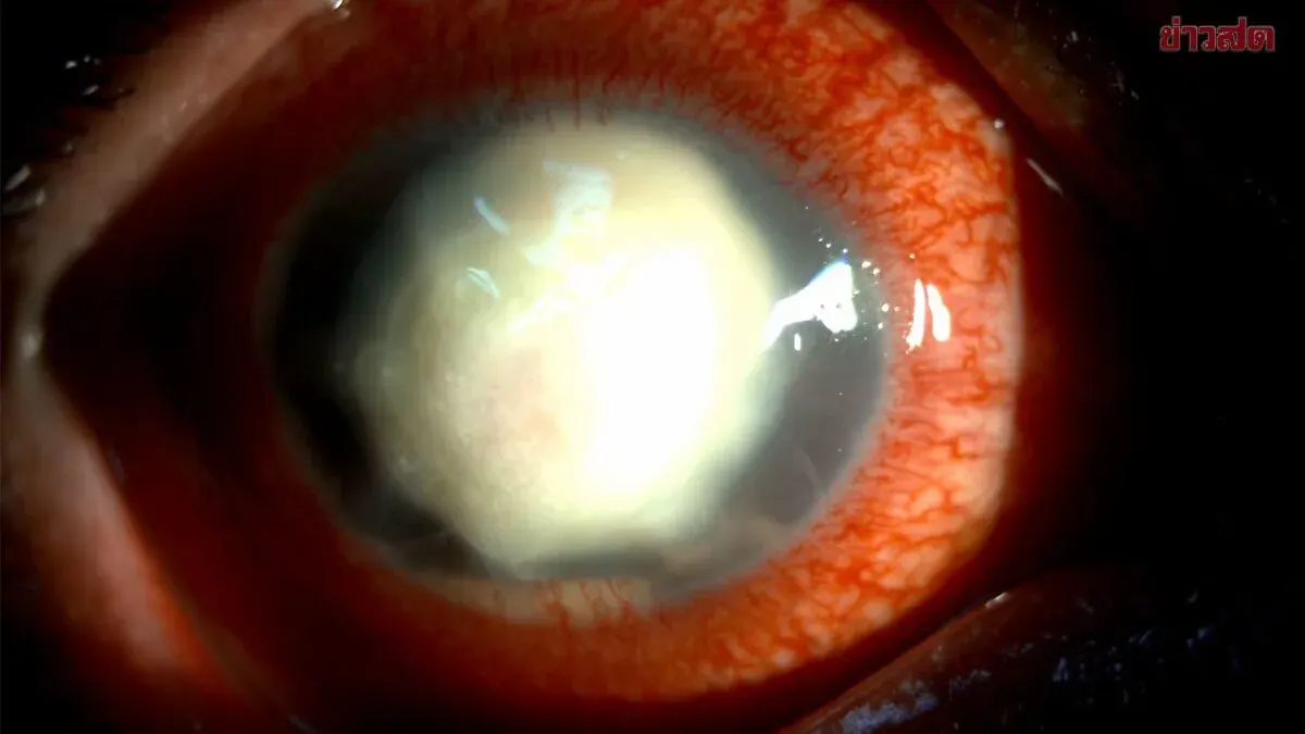 Insect in Eye Causes Fungal Infection, Corneal Rupture in Three Weeks