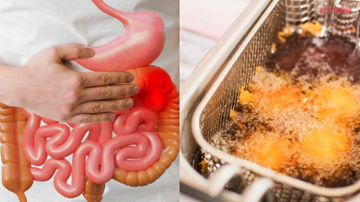 30-Year-Old's Daily Fried Rice Diet Leads to Colon Cancer