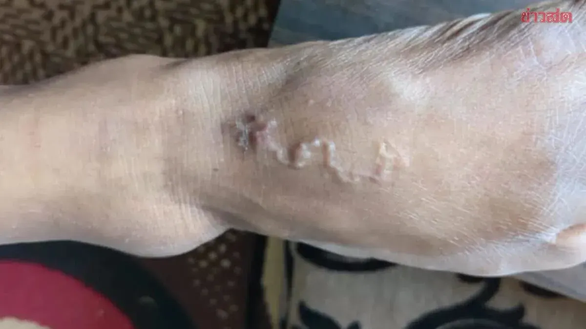 Man Diagnosed with Skin Parasite After Barefoot Rice Field Walk