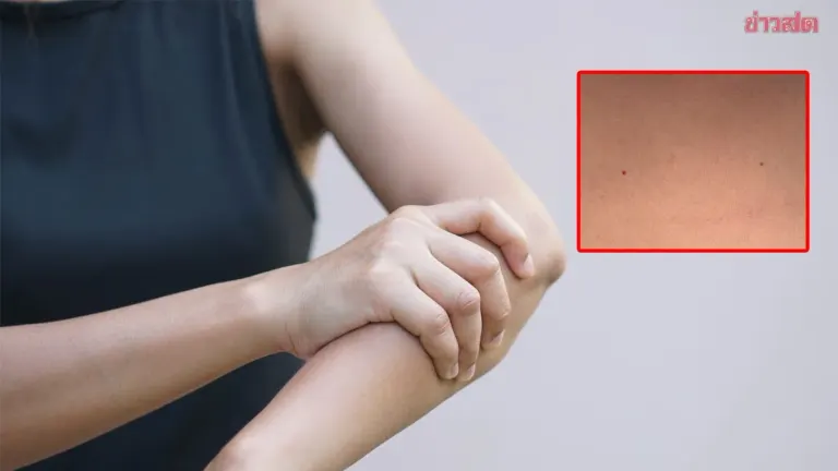 Red Bumps on Skin May Signal Serious Health Issues