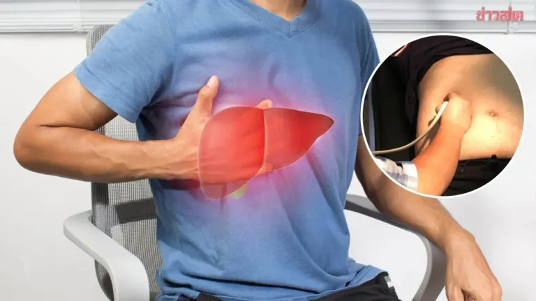 65-Year-Old's Liver Packed With Tumors After Month of Diarrhea