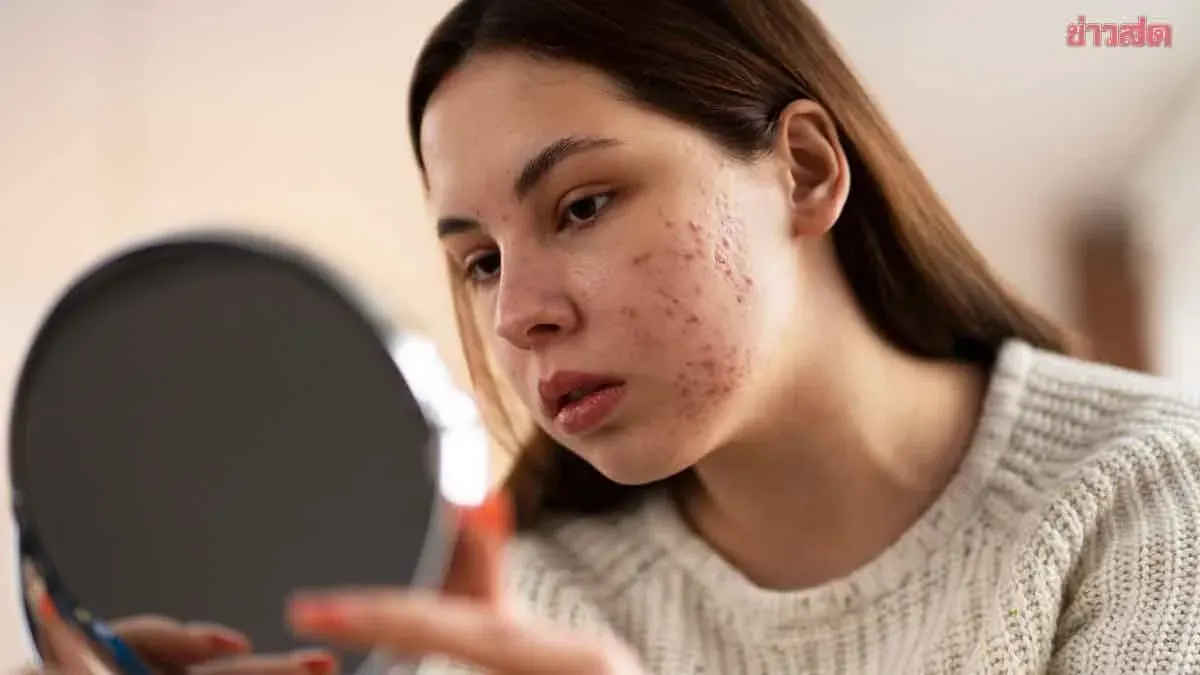 Acne Medication Types and Safe Usage Guide