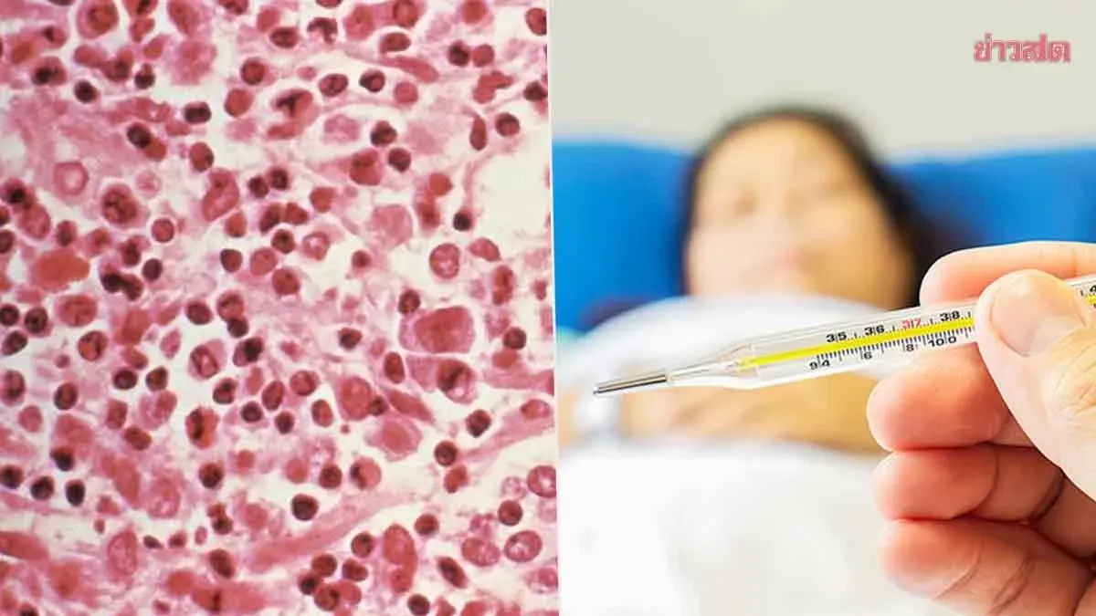 Health Ministry alerts public to Hantavirus; symptoms resemble flu but with high fatality rate