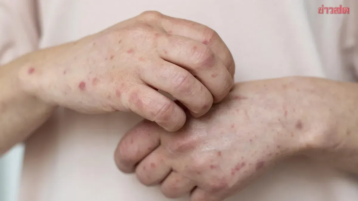 HIV Patient Diagnosed with Secondary Syphilis After Unprotected Sex