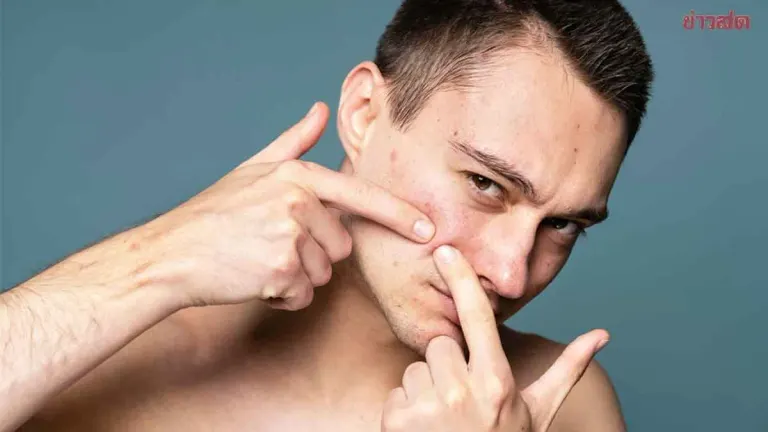 Safe Ways To Extract Clogged Pores At Home