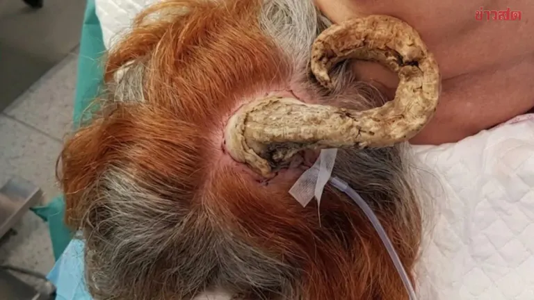 75-Year-Old Woman with 26cm Horn-Like Growth on Scalp Thought to Be Cursed, Doctors Discover Hidden Skin Cancer