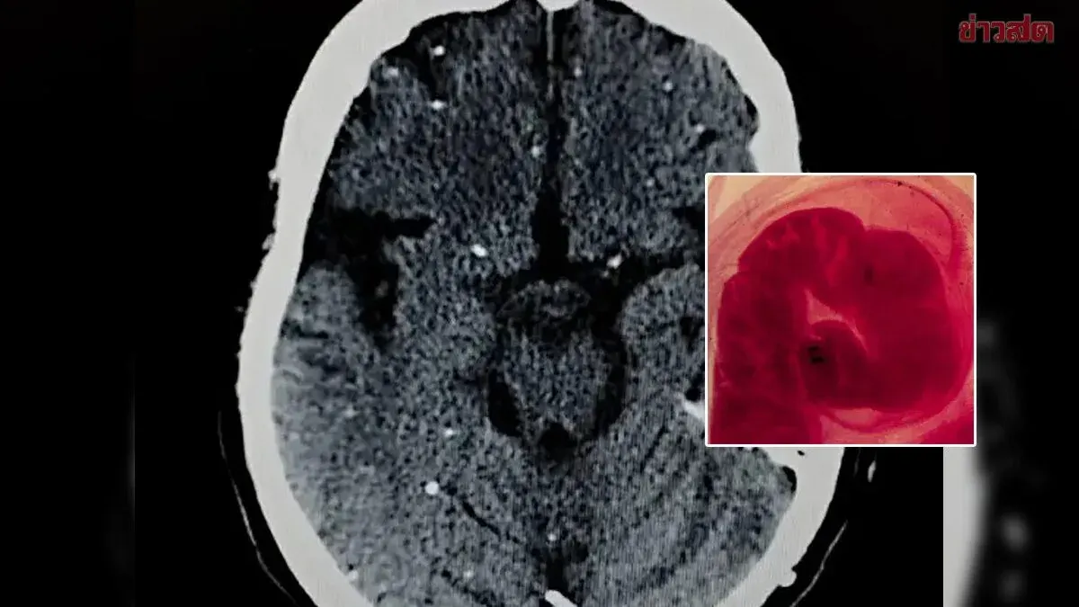 Spanish Man's Headaches Hide Rare Pork Tapeworm Brain Infection