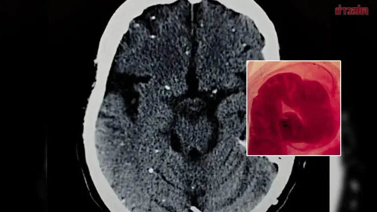 Spanish Man's Headaches Hide Rare Pork Tapeworm Brain Infection