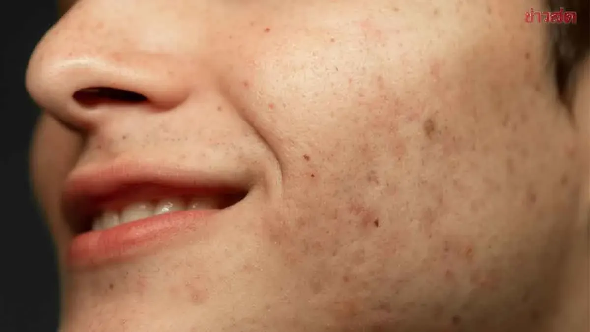 How To Fade Acne Scars With Targeted Skincare
