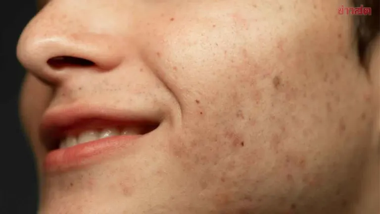 How To Fade Acne Scars With Targeted Skincare