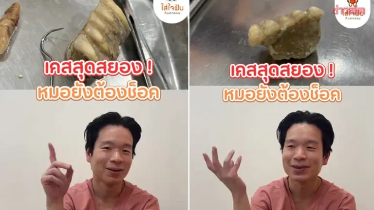 Dentist Shocked: Patient's Tartar Removal Reveals Entire Panel of Real Teeth—Initially Mistaken for Dentures