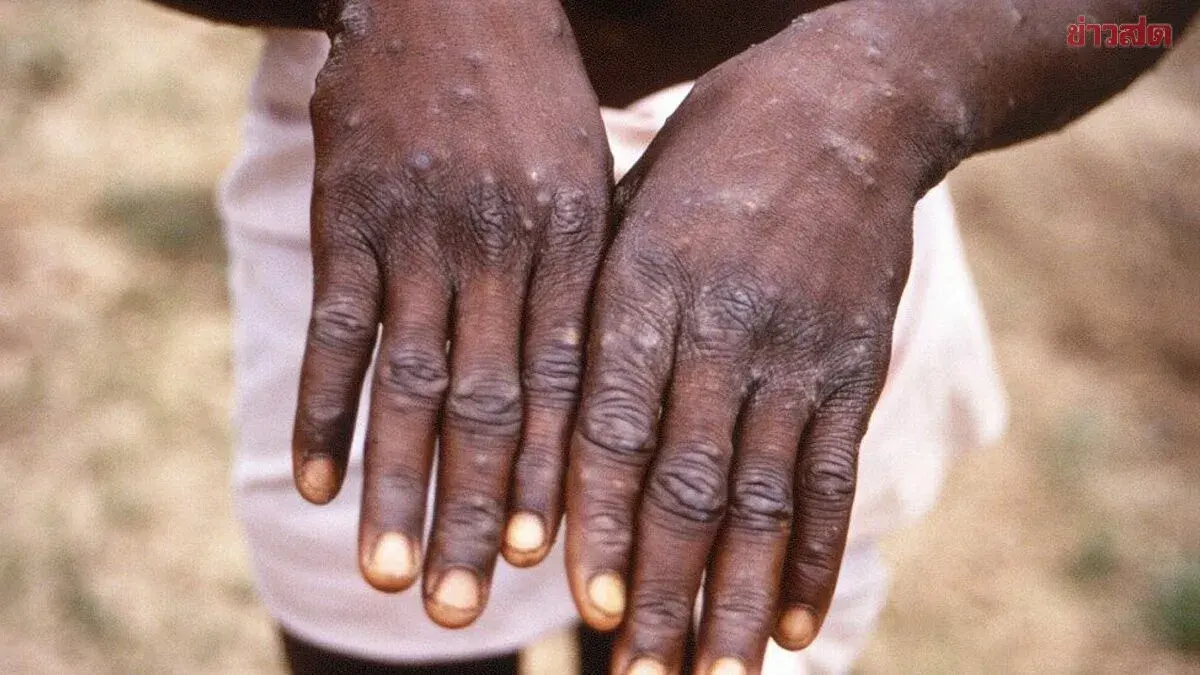 Health Ministry Reports Foreign Tourist Contracts Mpox After Contact with Strangers; Warns MSM Groups to Watch for Symptoms