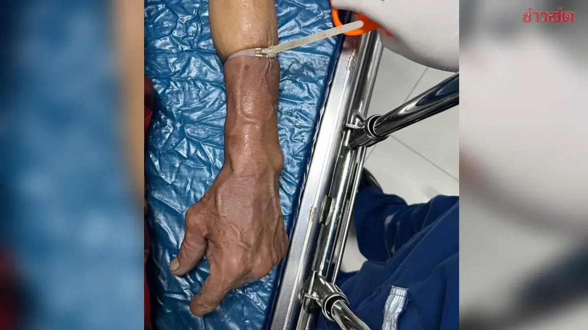 Doctor Warns Against Snake Bite Myth: Tourniquet Won't Prevent Venom, May Require Amputation