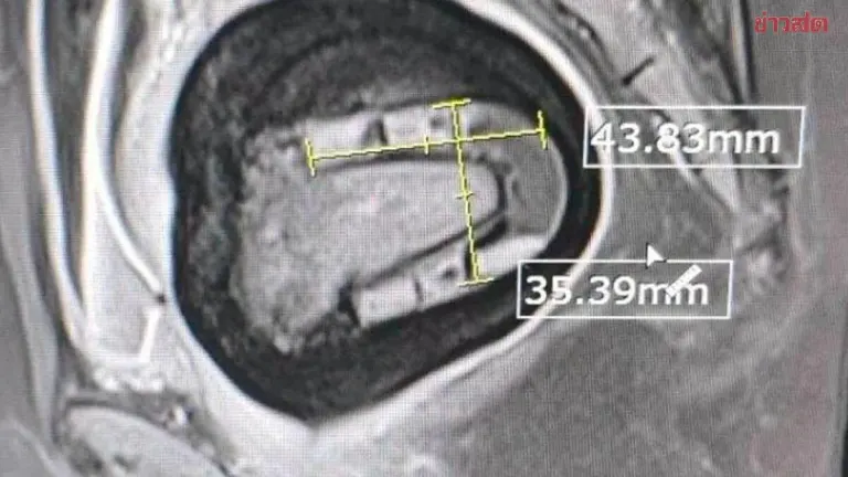 Doctors Surgically Remove Stone-Like Mass From Woman's Body